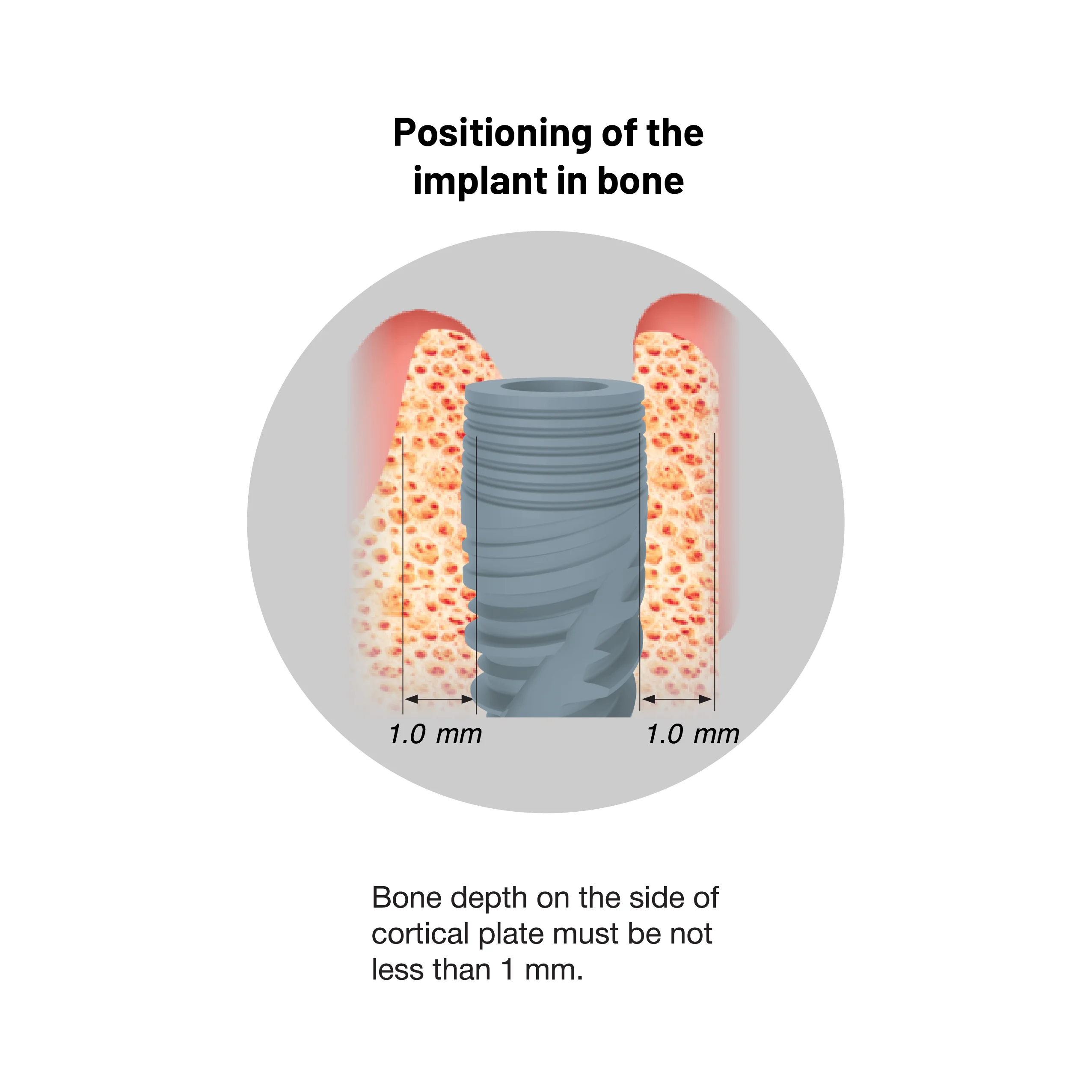 Positioning of implant in bone