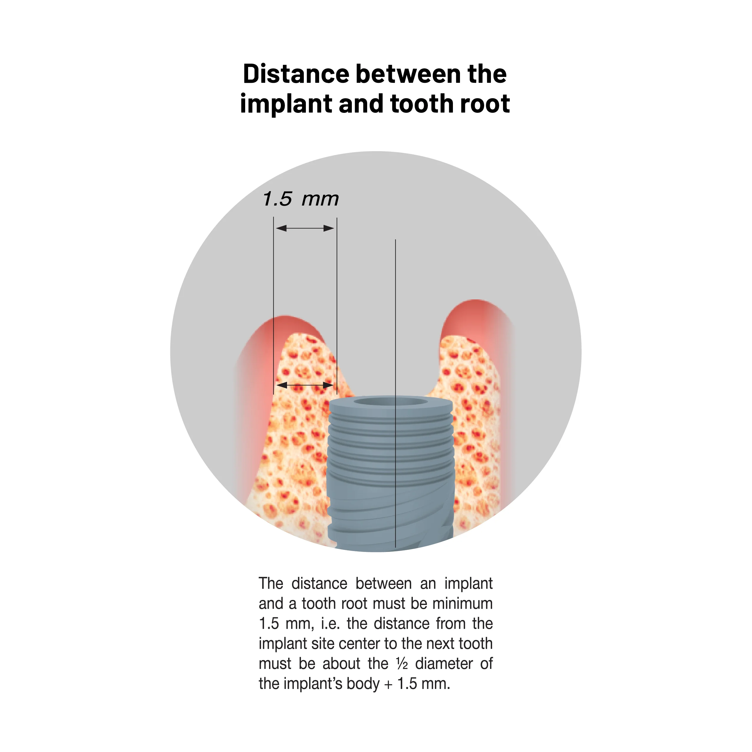 Distance between implant and tooth root